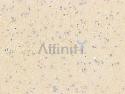 ZNF696 Antibody - DF15909 at 1/100 staining human glioblastoma by IHC-P.