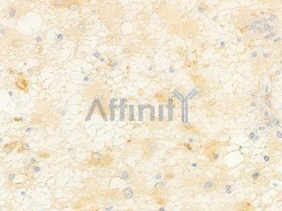 PROZ Antibody - DF15912 at 1/100 staining human astrocytoma by IHC-P.