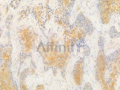 B3GALNT2 Antibody - DF15917 at 1/100 staining human breast carcinoma by IHC-P.