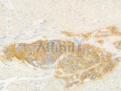 METTL21A Antibody - DF15919 at 1/100 staining human gastric carcinoma by IHC-P.
