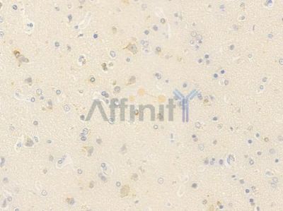 WDR20 Antibody - DF15922 at 1/100 staining human glioblastoma by IHC-P.