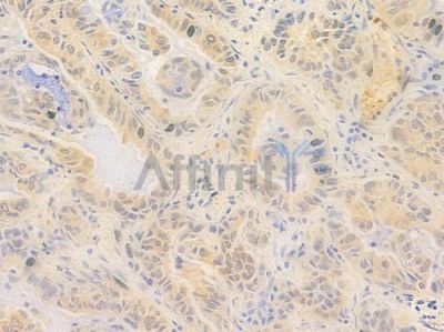 ZNF574 Antibody - DF15928 at 1/100 staining human lung adenocarcinoma by IHC-P.