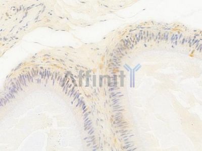 PRCC Antibody - DF15954 at 1/100 staining human testicular cancer by IHC-P.