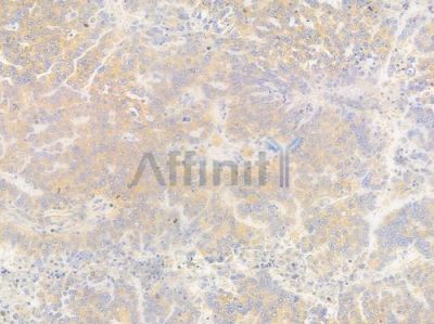 TFG Antibody - DF15955 at 1/100 staining human ovarian carcinoma by IHC-P.