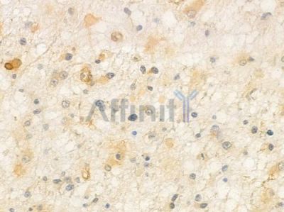 RWDD3 Antibody - DF16015 at 1/100 staining human astrocytoma by IHC-P.