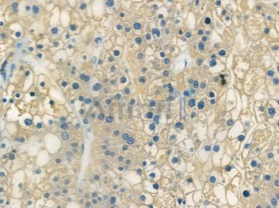 LRRC42 Antibody - DF2207 at 1/100 staining human hepatocellular carcinoma by IHC-P.