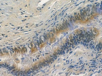 LDHAL6A Antibody - DF2208 at 1/100 staining human lung squamous cell carcinoma by IHC-P.