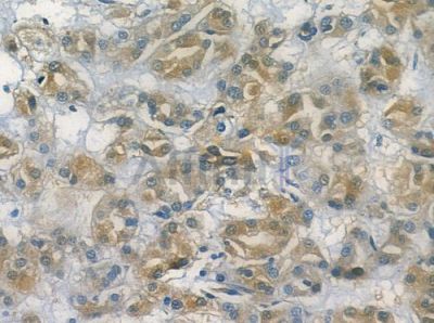 LDHAL6A Antibody - DF2208 at 1/100 staining human renal cell carcinoma by IHC-P.