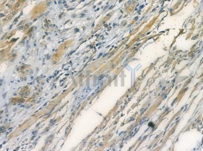 LDHAL6A Antibody - DF2208 at 1/100 staining human tongue carcinoma by IHC-P.
