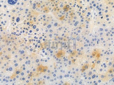ASPP2 Antibody - DF2275 at 1/100 staining human hepatocellular carcinoma by IHC-P.
