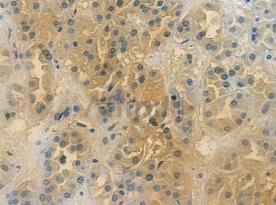 BCL2L10 Antibody - DF2276 at 1/100 staining human renal cell carcinoma by IHC-P.