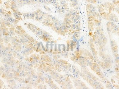 LAMC3 Antibody - DF2382 at 1/100 staining human renal cell carcinoma by IHC-P.