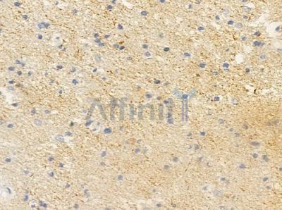 LAMC3 Antibody - DF2382 at 1/100 staining human glioblastoma by IHC-P.