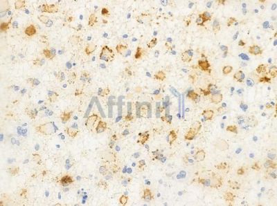 LAMC3 Antibody - DF2382 at 1/100 staining human astrocytoma by IHC-P.