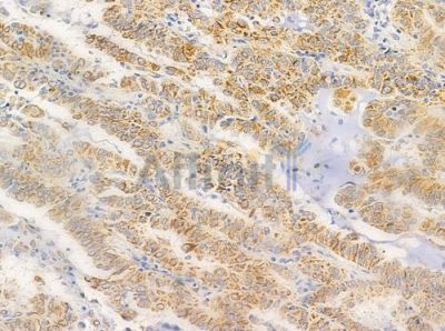 LAMC3 Antibody - DF2382 at 1/100 staining human lung adenocarcinoma by IHC-P.