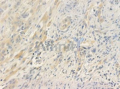 TCHP Antibody - DF2457 at 1/100 staining human tongue carcinoma by IHC-P.