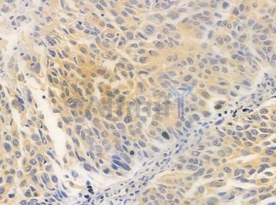 TCHP Antibody - DF2457 at 1/100 staining human lung squamous cell carcinoma by IHC-P.