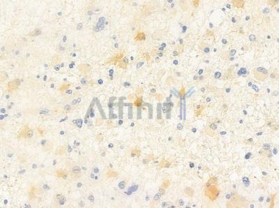 DUSP26 Antibody - DF2458 at 1/100 staining human astrocytoma by IHC-P.