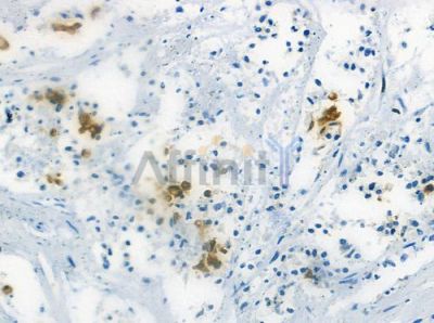 MED20 Antibody - DF2472 at 1/100 staining human breast carcinoma by IHC-P.