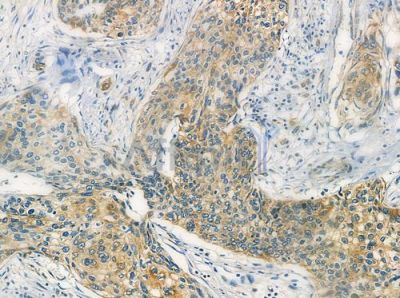 RRP7 Antibody - DF2485 at 1/100 staining human cervical carcinoma by IHC-P.