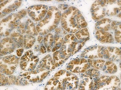 RRP7 Antibody - DF2485 at 1/100 staining human renal cell carcinoma by IHC-P.