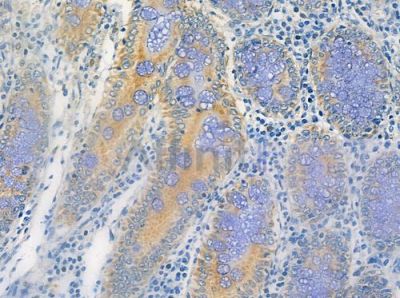 RRP7 Antibody - DF2485 at 1/100 staining human colon carcinoma by IHC-P.