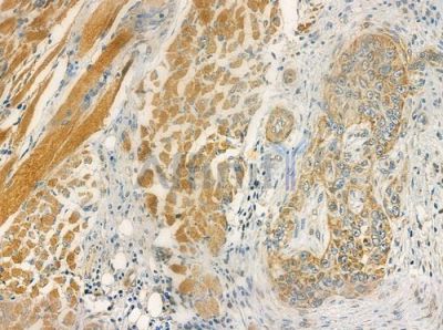 RRP7 Antibody - DF2485 at 1/100 staining human tongue carcinoma by IHC-P.