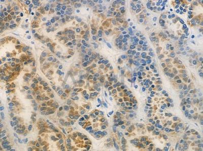 RRP7 Antibody - DF2485 at 1/100 staining human renal cell carcinoma by IHC-P.