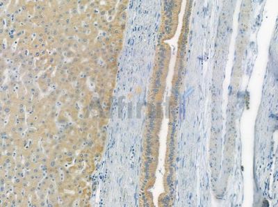 CYB5B Antibody - DF2488 at 1/100 staining human hepatocellular carcinoma by IHC-P.