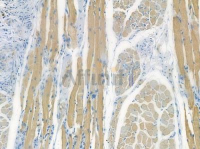 CYB5B Antibody - DF2488 at 1/100 staining human tongue carcinoma by IHC-P.