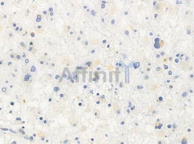 FGF17 Antibody - DF2495 at 1/100 staining human astrocytoma by IHC-P.