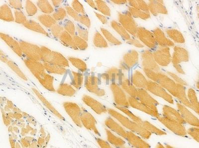 FGF17 Antibody - DF2495 at 1/100 staining human tongue carcinoma by IHC-P.