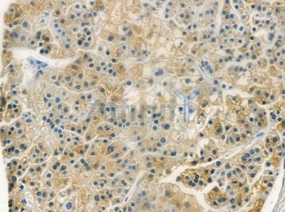 Interleukin 20 Antibody - DF2527 at 1/100 staining human hepatocellular carcinoma by IHC-P.