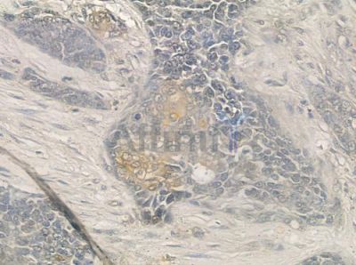 K2C1B Antibody - DF2555 at 1/100 staining human breast carcinoma by IHC-P.