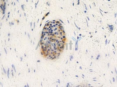 KRT81 Antibody - DF2559 at 1/100 staining human pancreatic carcinoma by IHC-P.