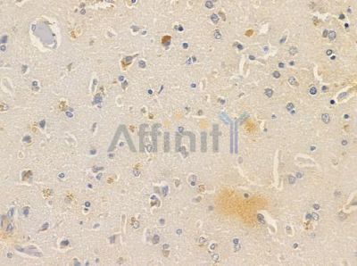 CNNM3 Antibody - DF2572 at 1/100 staining human glioblastoma by IHC-P.