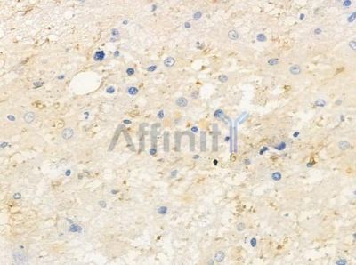 CNNM3 Antibody - DF2572 at 1/100 staining human astrocytoma by IHC-P.