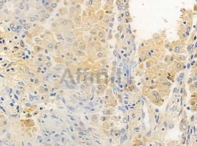 CNNM3 Antibody - DF2572 at 1/100 staining human lung squamous cell carcinoma by IHC-P.