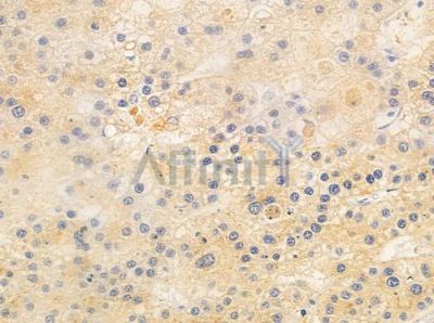 CNNM3 Antibody - DF2572 at 1/100 staining human hepatocellular carcinoma by IHC-P.