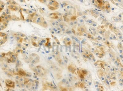 CNNM3 Antibody - DF2572 at 1/100 staining human renal cell carcinoma by IHC-P.