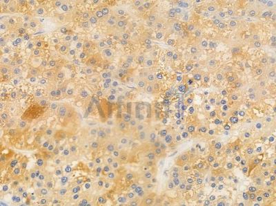 Cytochrome P450 3A43 Antibody - DF2616 at 1/100 staining human hepatocellular carcinoma by IHC-P.