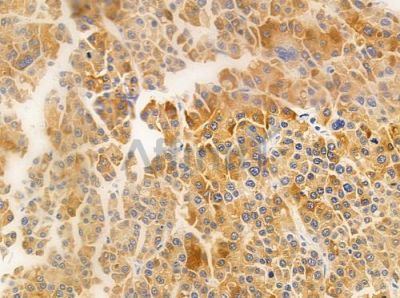 Cytochrome P450 3A43 Antibody - DF2616 at 1/100 staining human hepatocellular carcinoma by IHC-P.