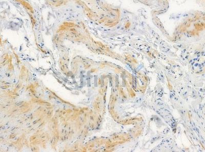 Cytochrome P450 3A43 Antibody - DF2620 at 1/100 staining human testicular cancer by IHC-P.