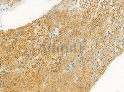 Cytochrome P450 3A43 Antibody - DF2620 at 1/100 staining human colon carcinoma by IHC-P.