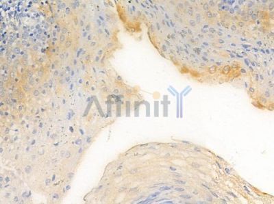 PI 3 Kinase Class 2A Antibody - DF2623 at 1/100 staining human lung squamous cell carcinoma by IHC-P.