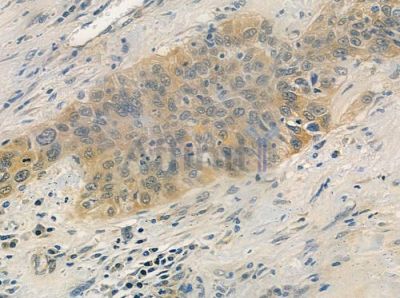 DYNLL1 Antibody - DF2630 at 1/100 staining human esophageal carcinoma by IHC-P.