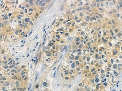DYNLL1 Antibody - DF2630 at 1/100 staining human lung squamous cell carcinoma by IHC-P.
