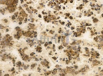 ING4 Antibody - DF2635 at 1/100 staining human melanoma by IHC-P.