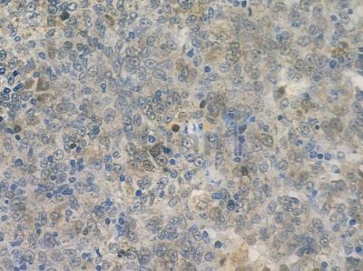 RASEF Antibody - DF2646 at 1/100 staining human melanoma by IHC-P.