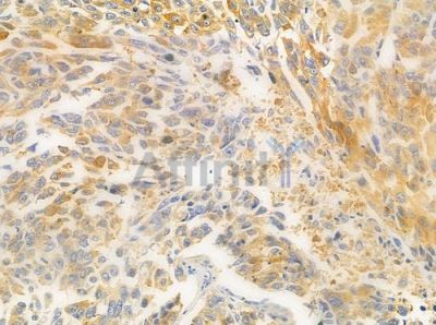 CLK3 Antibody - DF2662 at 1/100 staining human lung squamous cell carcinoma by IHC-P.